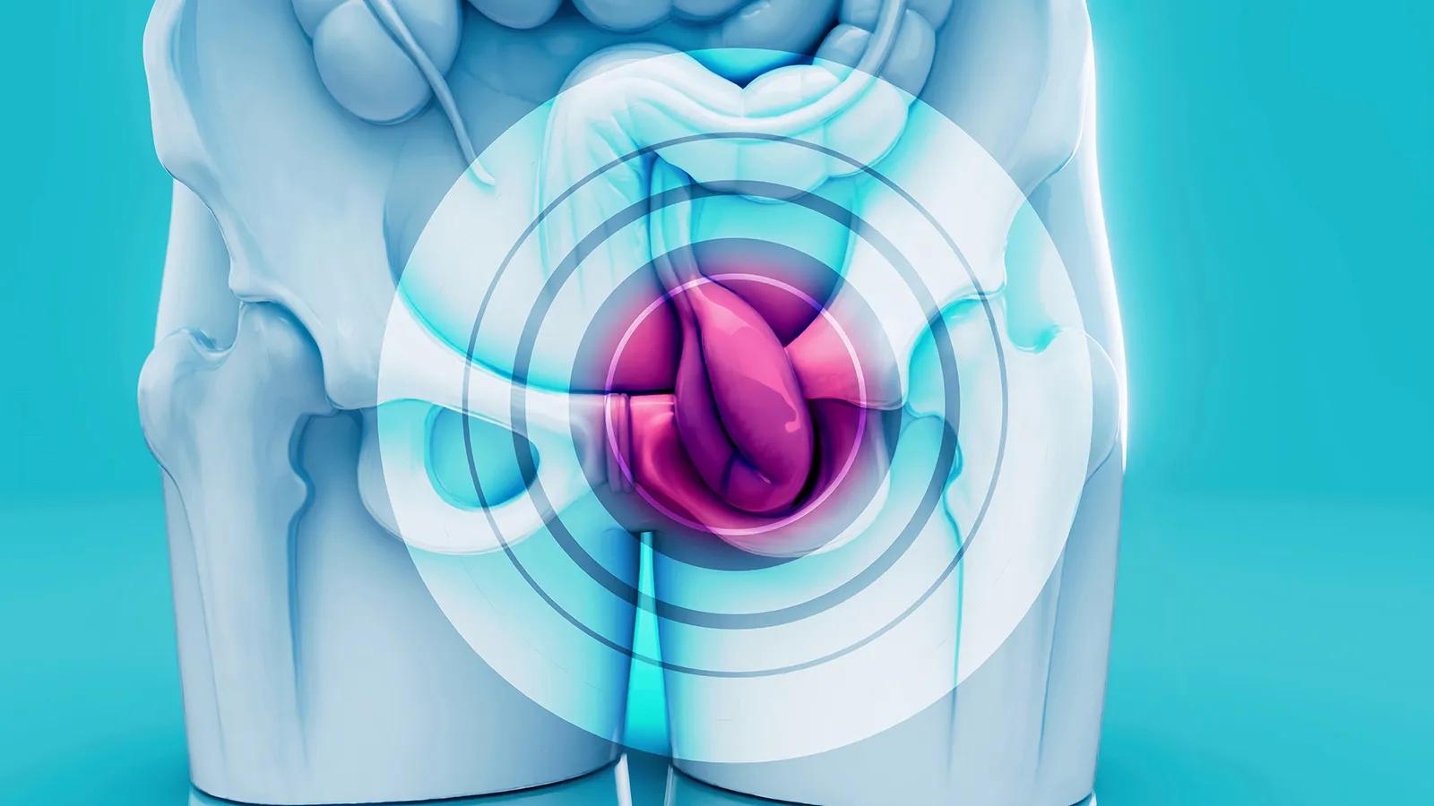 Kronik Prostatit İçin ESWT (Şok Dalga) Uygulaması